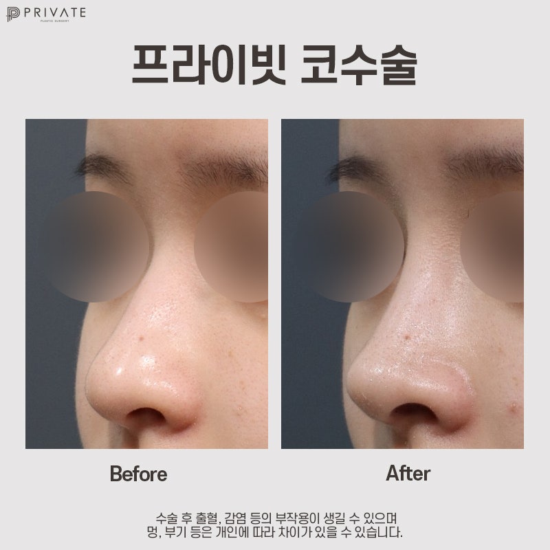 Private Plastic Surgery, Rekomendasi Tempat Bedah Hidung Terbaik 사진 9
