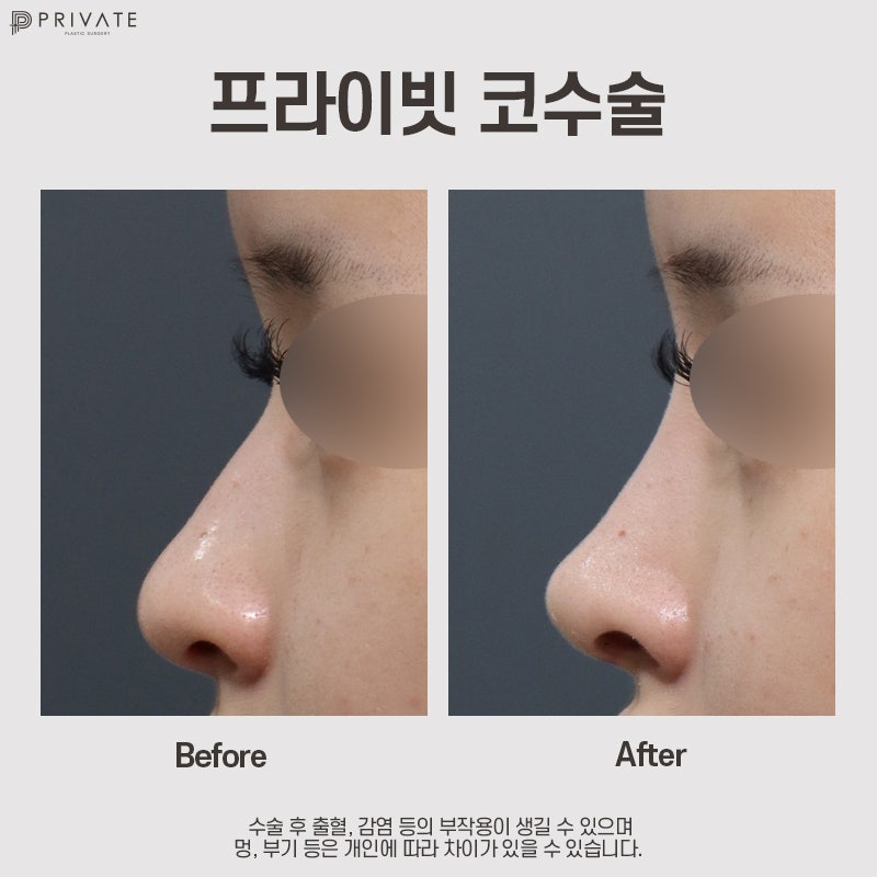 Private Plastic Surgery, Rekomendasi Tempat Bedah Hidung Terbaik 사진 10