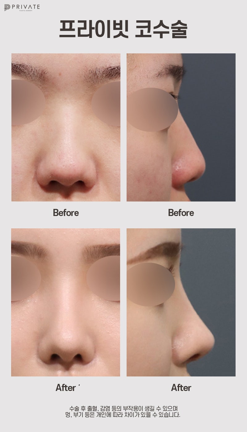 福鼻整形手术好评在Private整形外科 사진 8
