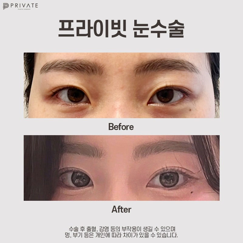 Tempat Terbaik untuk Operasi Kelopak Mata Ganda Semi-Out: Private Plastic Surgery Clinic 사진 8