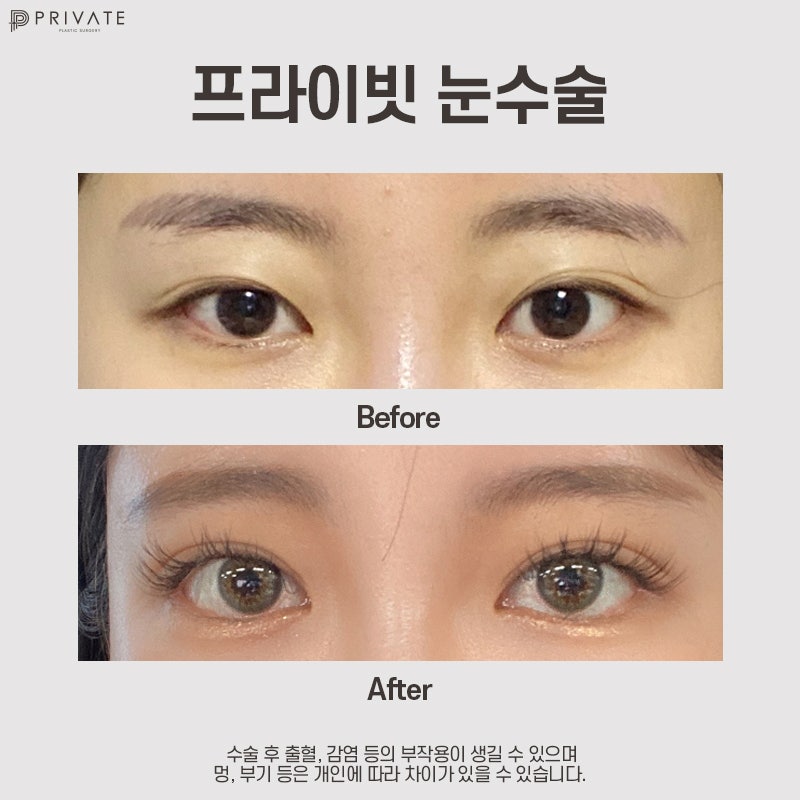 Tempat Terbaik untuk Operasi Kelopak Mata Ganda Semi-Out: Private Plastic Surgery Clinic 사진 9