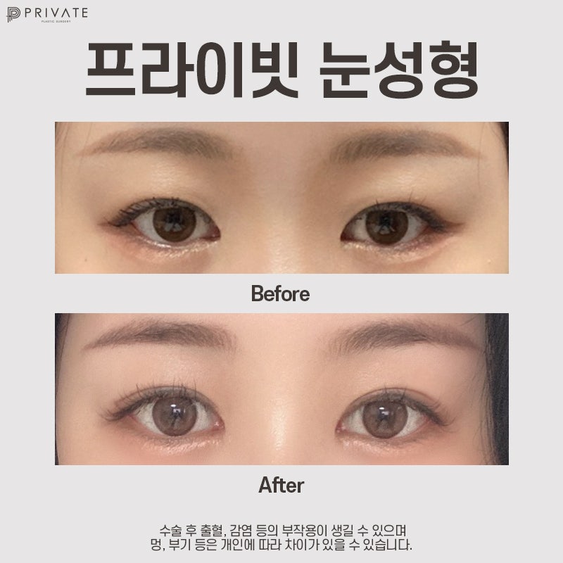 Private Plastic Surgery Clinic dengan Ulasan Sayatan Kelopak Mata Ganda yang Baik 사진 9
