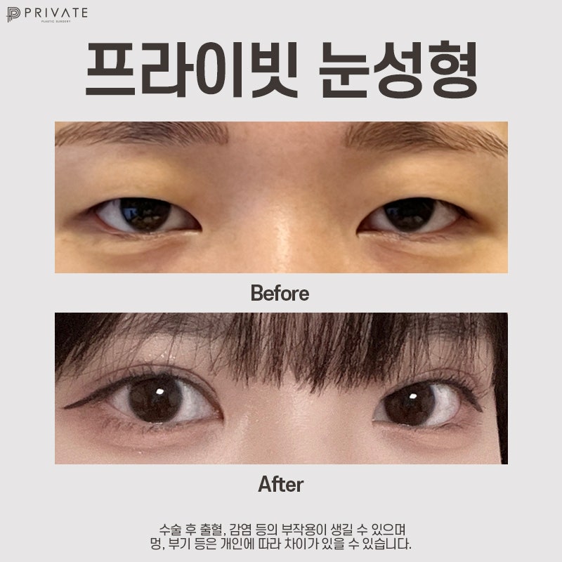 Private Plastic Surgery Clinic dengan Ulasan Sayatan Kelopak Mata Ganda yang Baik 사진 8