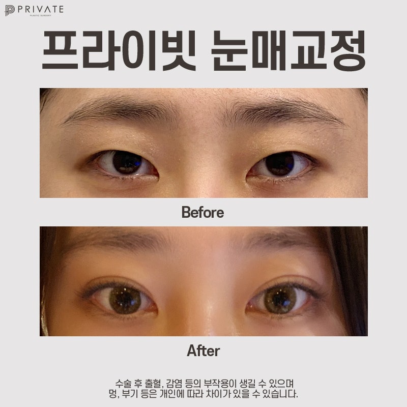 Private Plastic Surgery Clinic: Eyelid Correction and Double Eyelid Surgery 사진 10