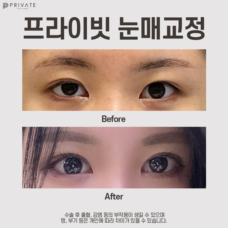 Private Plastic Surgery Clinic: Eyelid Correction and Double Eyelid Surgery 사진 9