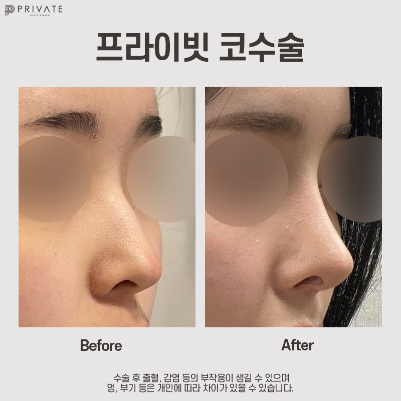 낮은코성형후기 볼 수 있는 프라이빗성형외과 사진 8