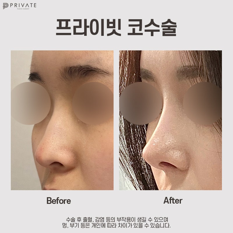 낮은코성형후기 볼 수 있는 프라이빗성형외과 사진 9