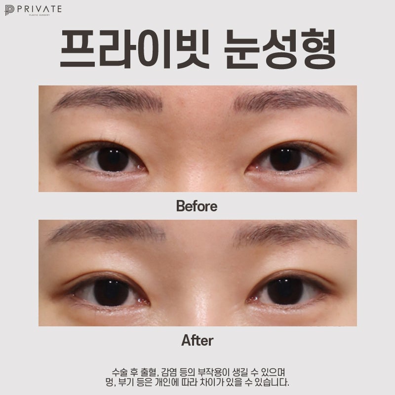 Tempat Terbaik untuk Operasi Kelopak Mata Ganda Alami adalah Private Plastic Surgery 사진 9