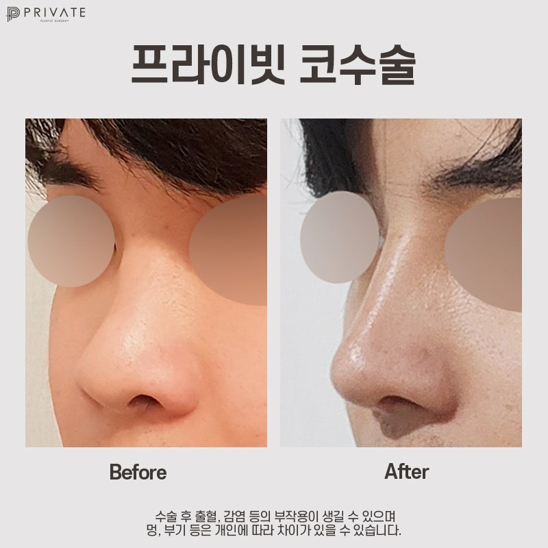Mengenal Operasi Rhinoplasty Tulang Rawan Rusuk Autologus di Private Plastic Surgery 사진 10