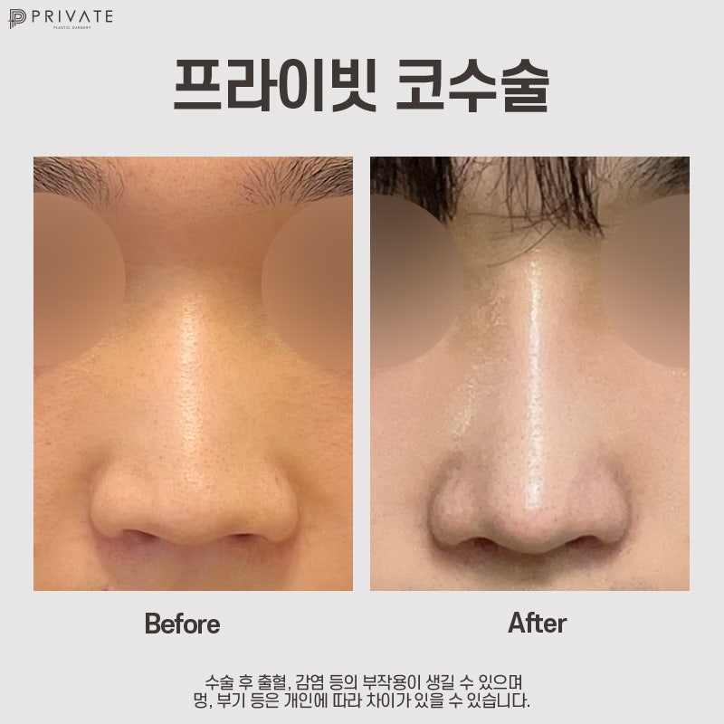 Mengenal Operasi Rhinoplasty Tulang Rawan Rusuk Autologus di Private Plastic Surgery 사진 8