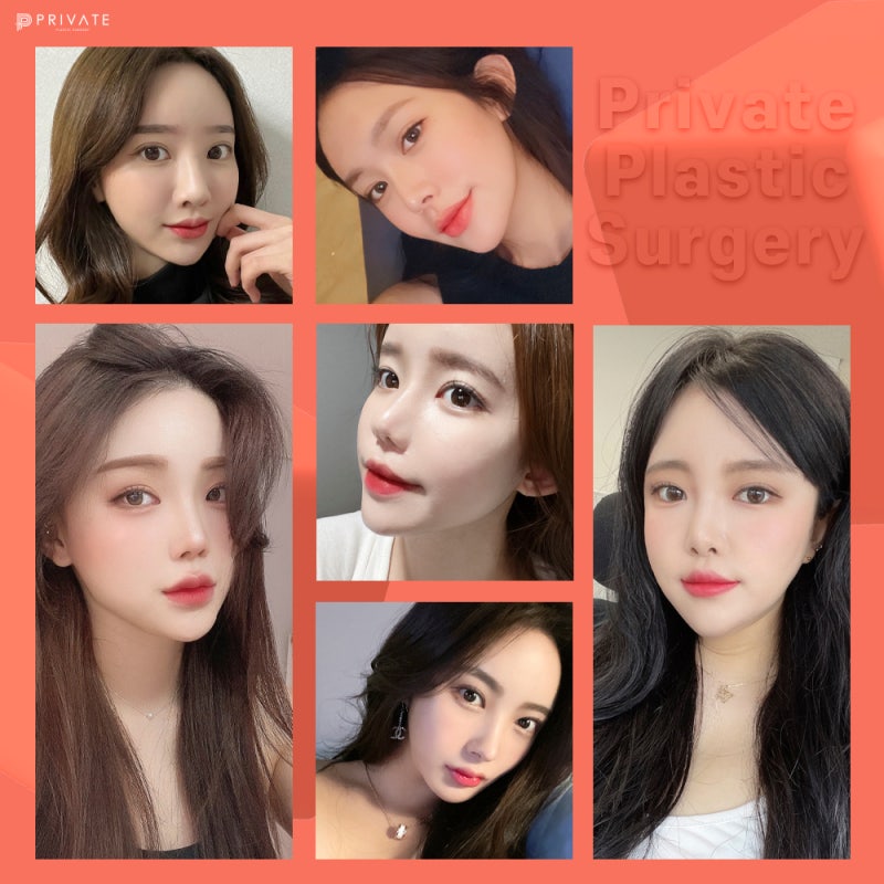 Mengenal Operasi Rhinoplasty Tulang Rawan Rusuk Autologus di Private Plastic Surgery 사진 7