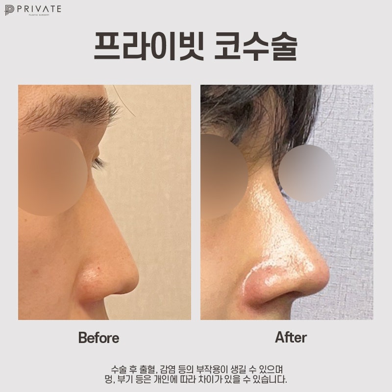 Mengenal Operasi Rhinoplasty Tulang Rawan Rusuk Autologus di Private Plastic Surgery 사진 9