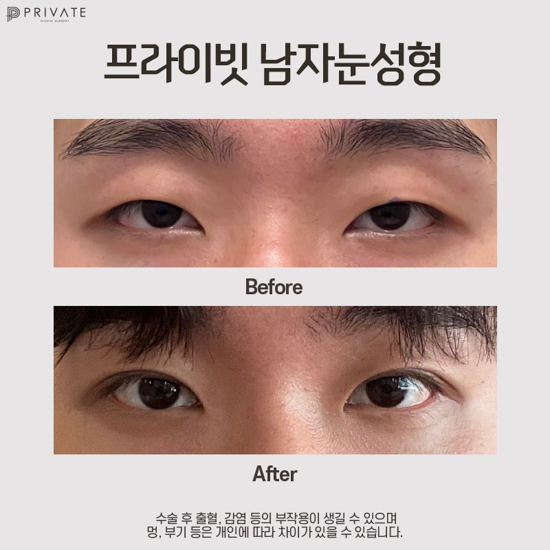 프라이빗성형외과 남자눈성형수술 사진 8