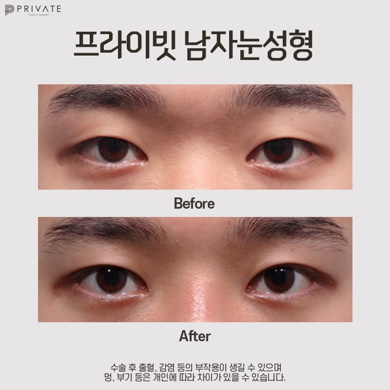 프라이빗성형외과 남자눈성형수술 사진 7