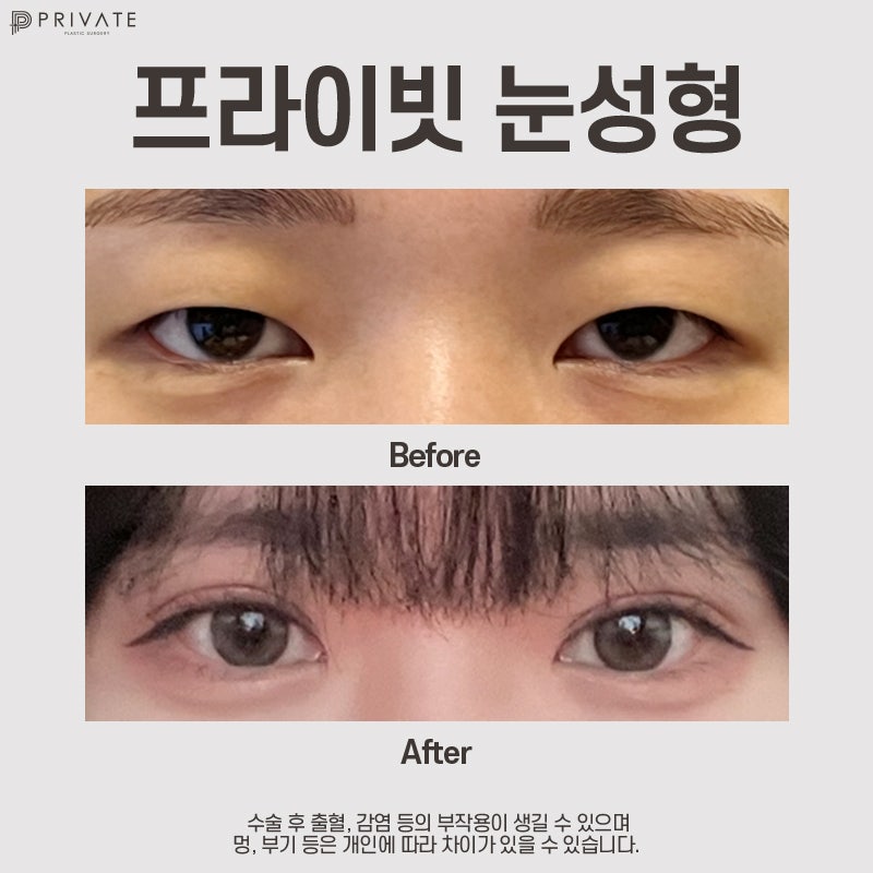 Operasi Mata Ganda Koreksi Mata di Private Plastic Surgery Clinic dengan Tingkat Kepuasan Tinggi 사진 7
