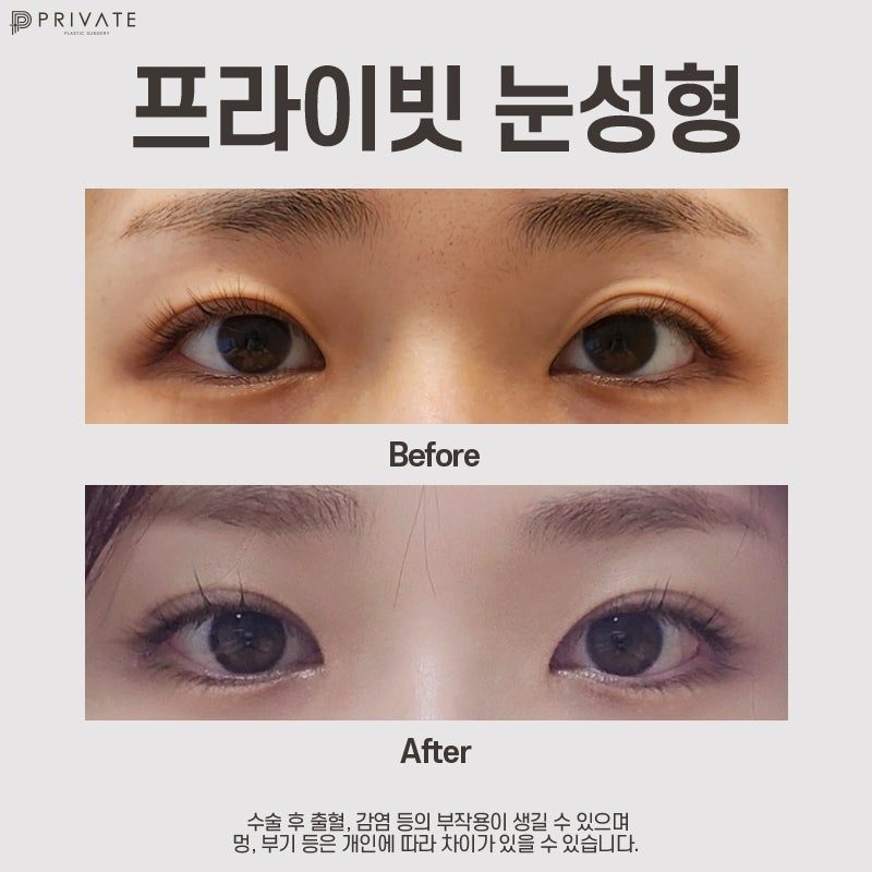 Operasi Mata Ganda Koreksi Mata di Private Plastic Surgery Clinic dengan Tingkat Kepuasan Tinggi 사진 8