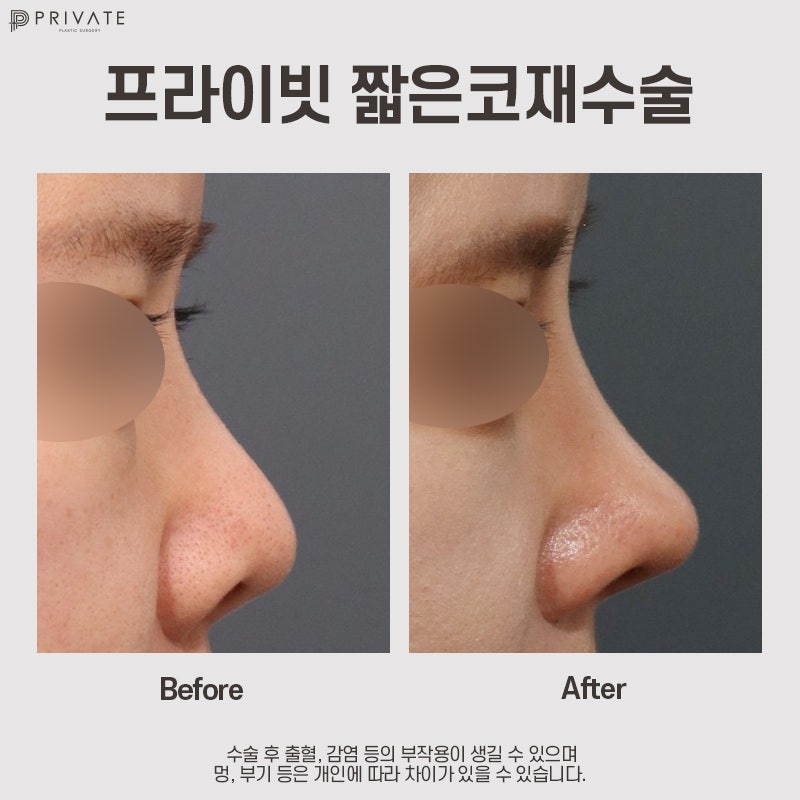 Operasi Hidung Pendek Revisi di Private Plastic Surgery 사진 12