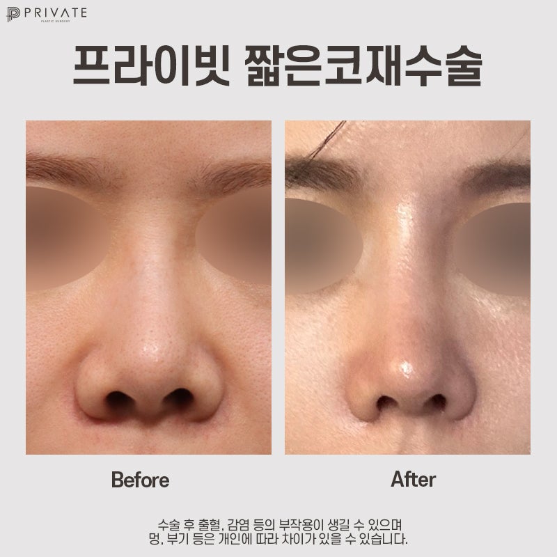 Operasi Hidung Pendek Revisi di Private Plastic Surgery 사진 10