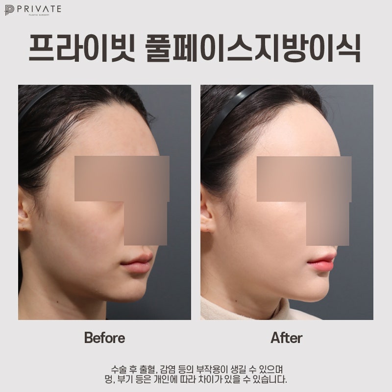 Jika Anda Penasaran dengan Perbedaan Sebelum dan Sesudah Transplantasi Lemak Wajah, Kunjungi Private Plastic Surgery 사진