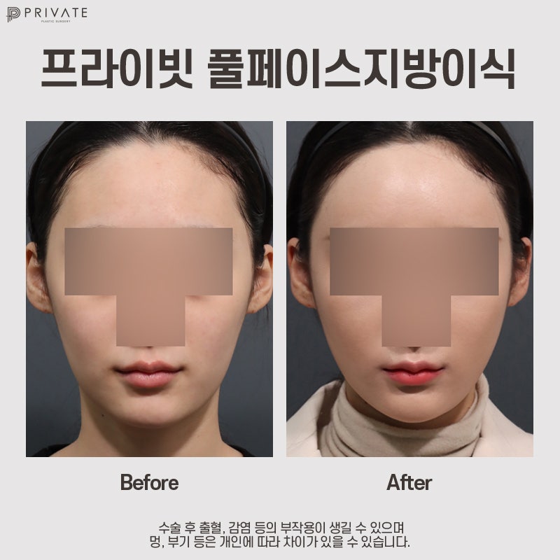 Jika Anda Penasaran dengan Perbedaan Sebelum dan Sesudah Transplantasi Lemak Wajah, Kunjungi Private Plastic Surgery 사진