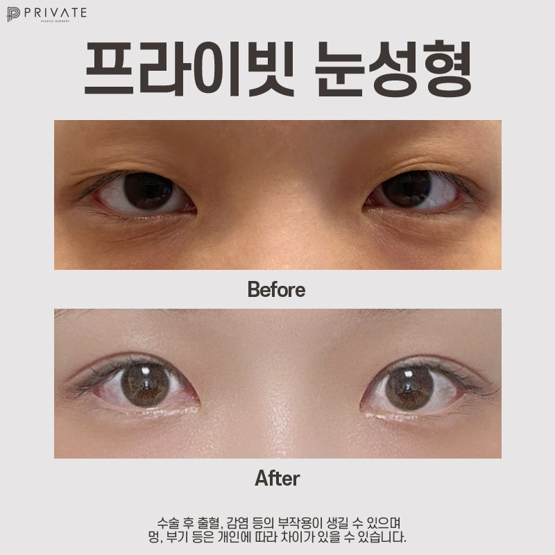 Operasi Kelopak Mata Ganda di Private Plastic Surgery 사진 9