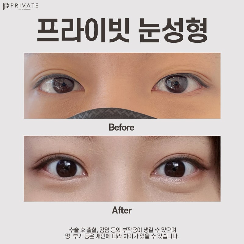 Operasi Kelopak Mata Ganda di Private Plastic Surgery 사진 10
