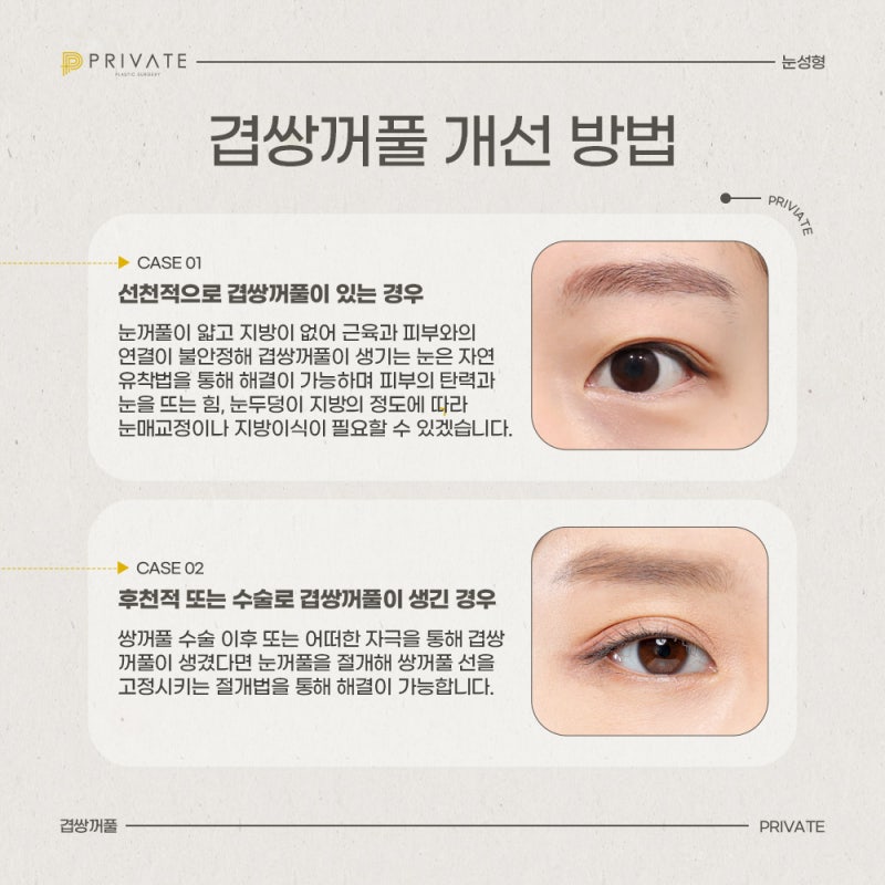 Operasi Kelopak Mata Ganda di Private Plastic Surgery 사진 4