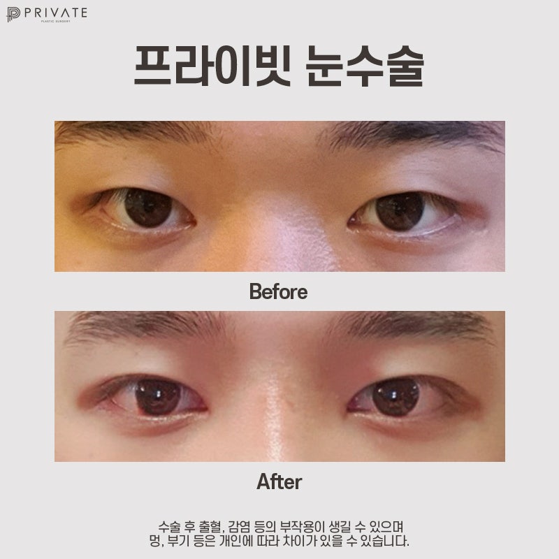 Мужская пластика век в Private Plastic Surgery 사진 8