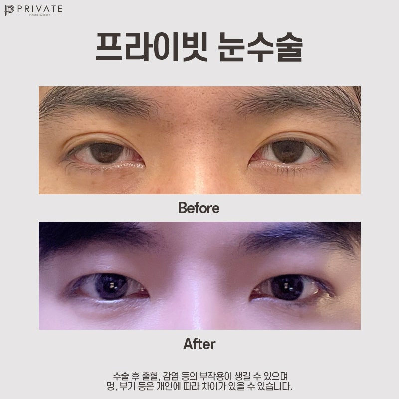 Мужская пластика век в Private Plastic Surgery 사진 7