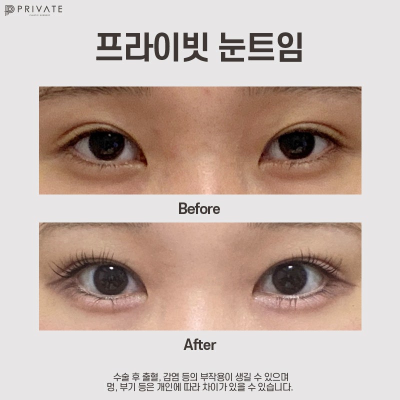 Operasi Plastik Full Trimming di Private Plastic Surgery 사진 8