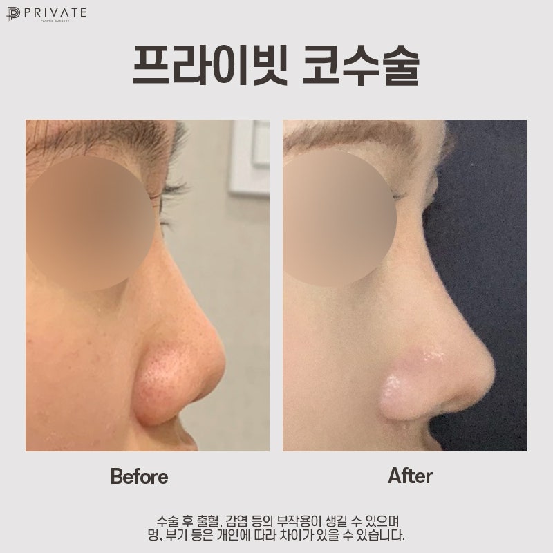 Ulasan Operasi Hidung Rendah Terbaik, Klinik Bedah Plastik Private di Sinsa 사진 10