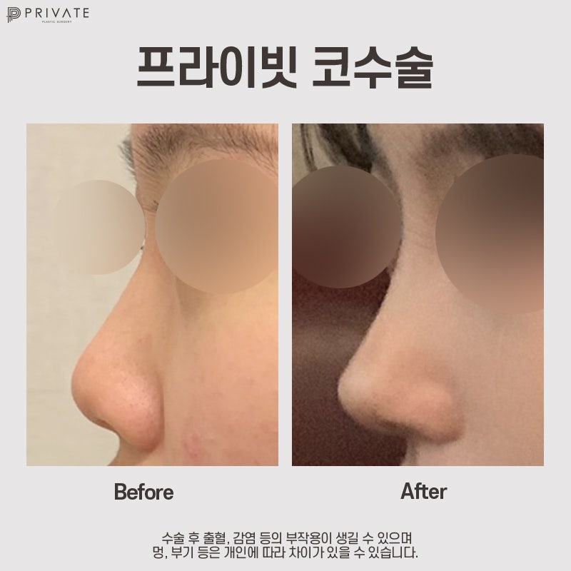 Ulasan Operasi Hidung Rendah Terbaik, Klinik Bedah Plastik Private di Sinsa 사진 9