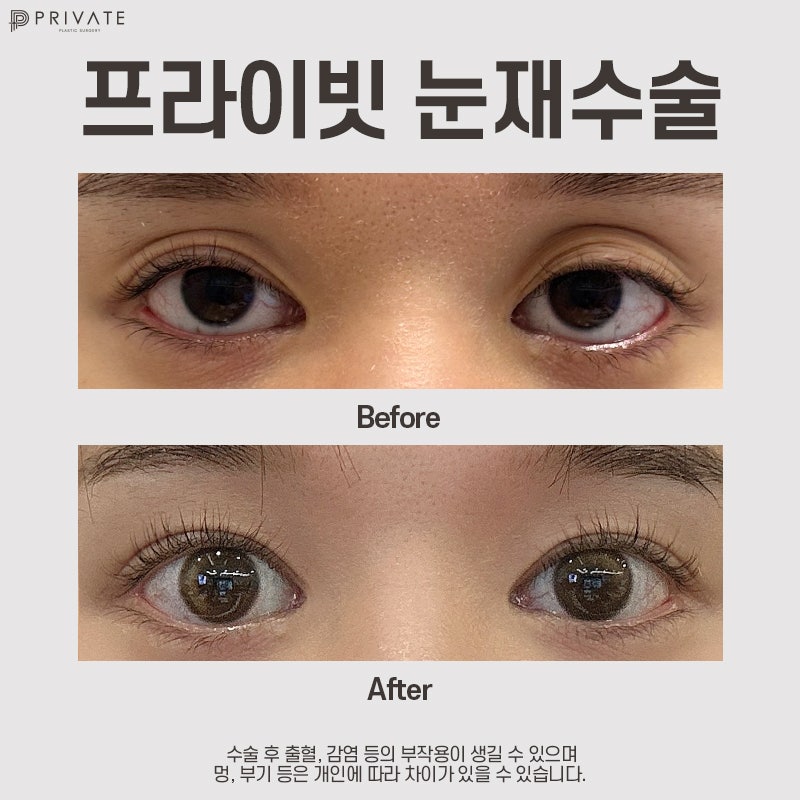 쌍수 재수술 후기가 좋은 프라이빗성형외과 사진 10