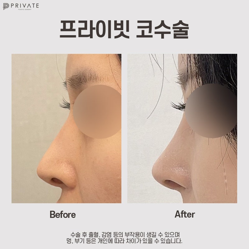 Operasi Hidung dengan Tulang Rawan Rusuk Sendiri, Cari Tahu di Private Plastic Surgery 사진 10