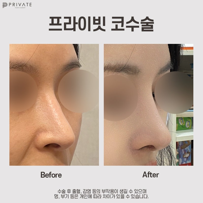 Operasi Hidung dengan Tulang Rawan Rusuk Sendiri, Cari Tahu di Private Plastic Surgery 사진 9