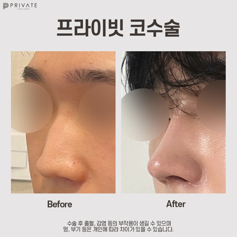 Operasi Hidung dengan Tulang Rawan Rusuk Sendiri, Cari Tahu di Private Plastic Surgery 사진 8