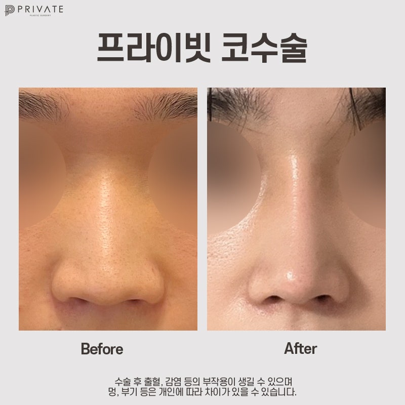 Operasi Hidung dengan Tulang Rawan Rusuk Sendiri, Cari Tahu di Private Plastic Surgery 사진 7