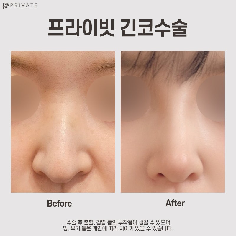 긴코수술잘하는곳은 프라이빗성형외과 사진 8