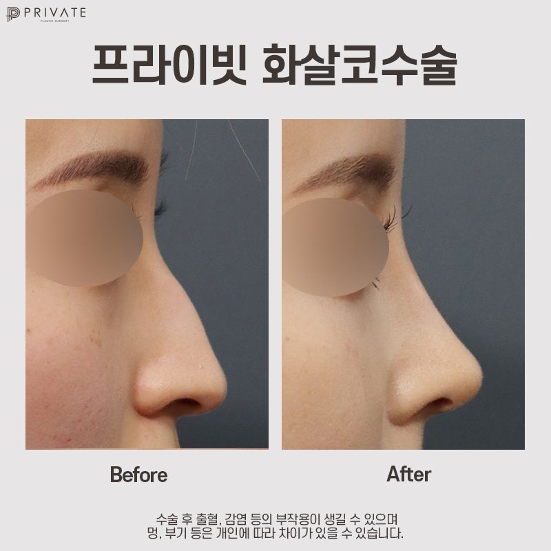 화살코성형후기가 좋은 프라이빗성형외과 사진 9