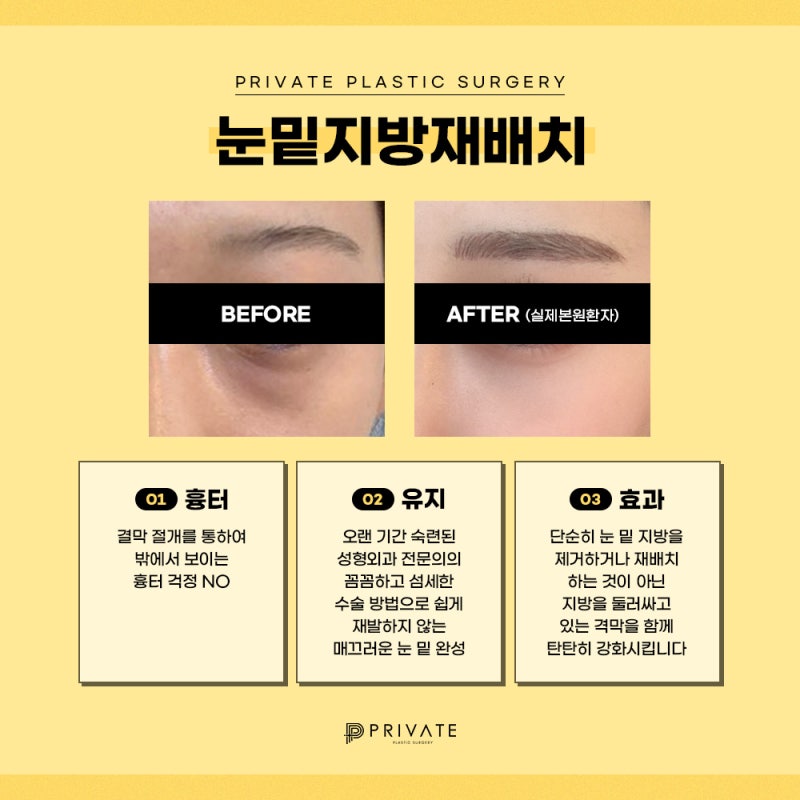 Klinik Bedah Plastik Pribadi dengan Ulasan Bagus untuk Penataan Ulang Lemak Bawah Mata 사진 5