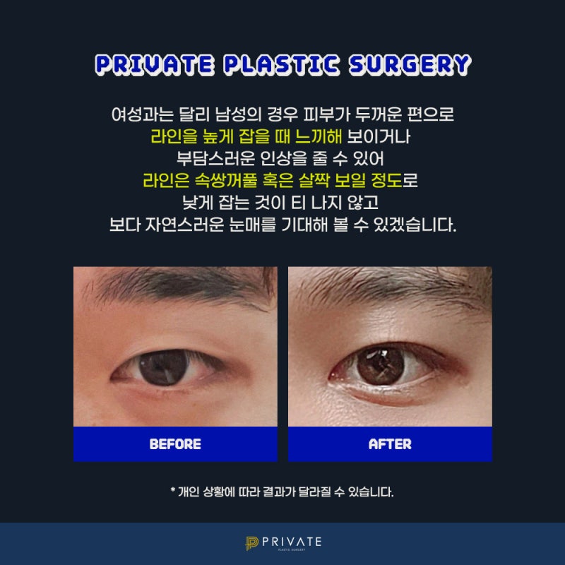 男士双眼皮手术好评如潮的私密整形外科