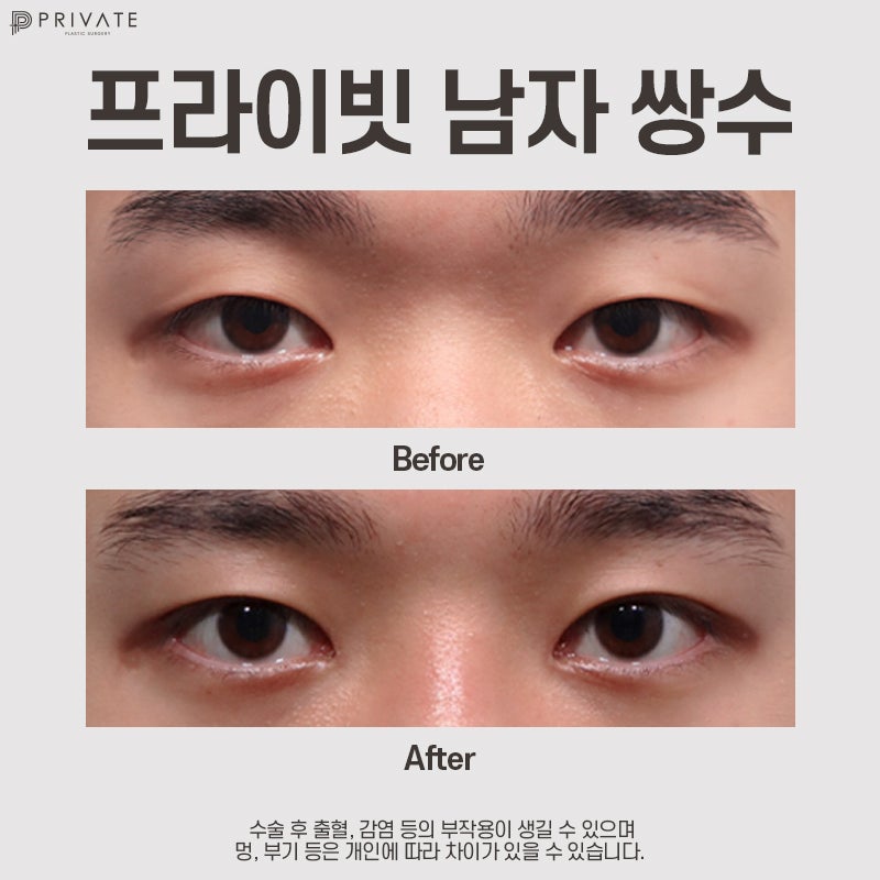 男士双眼皮手术好评如潮的私密整形外科 사진 10