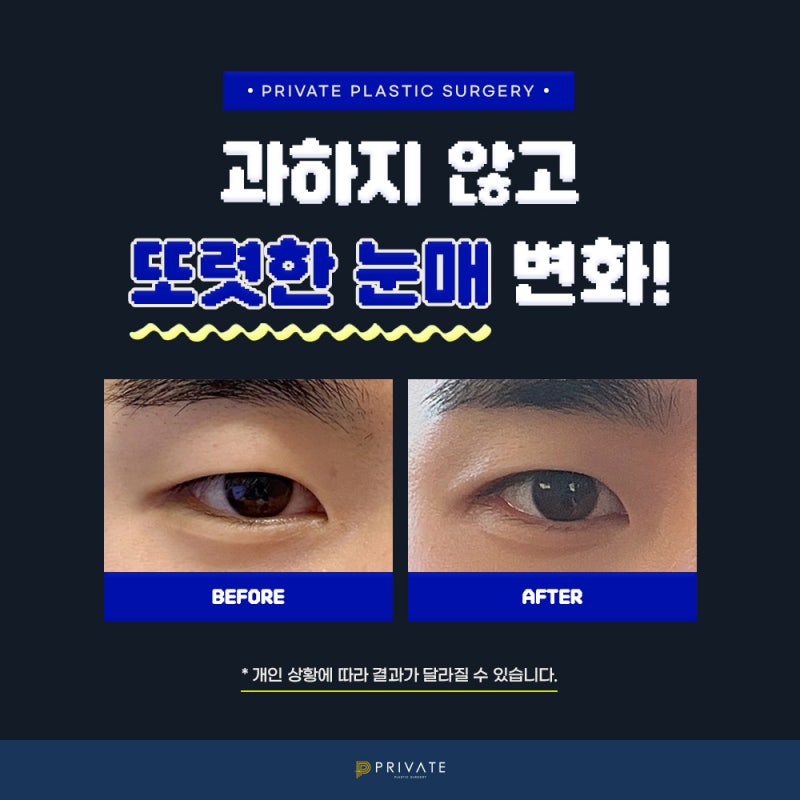 男士双眼皮手术好评如潮的私密整形外科 사진 7