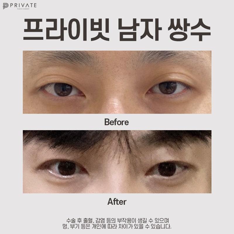 男士双眼皮手术好评如潮的私密整形外科 사진 8