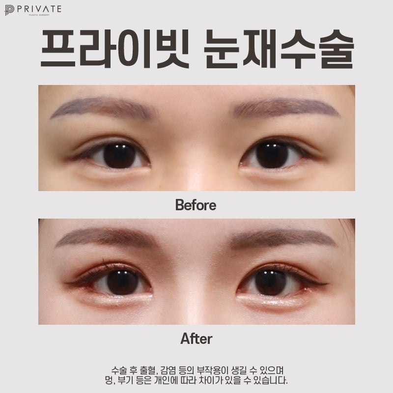 Jika Anda mencari tempat yang bagus untuk operasi revisi kelopak mata ganda, Private Plastic Surgery adalah jawabannya.