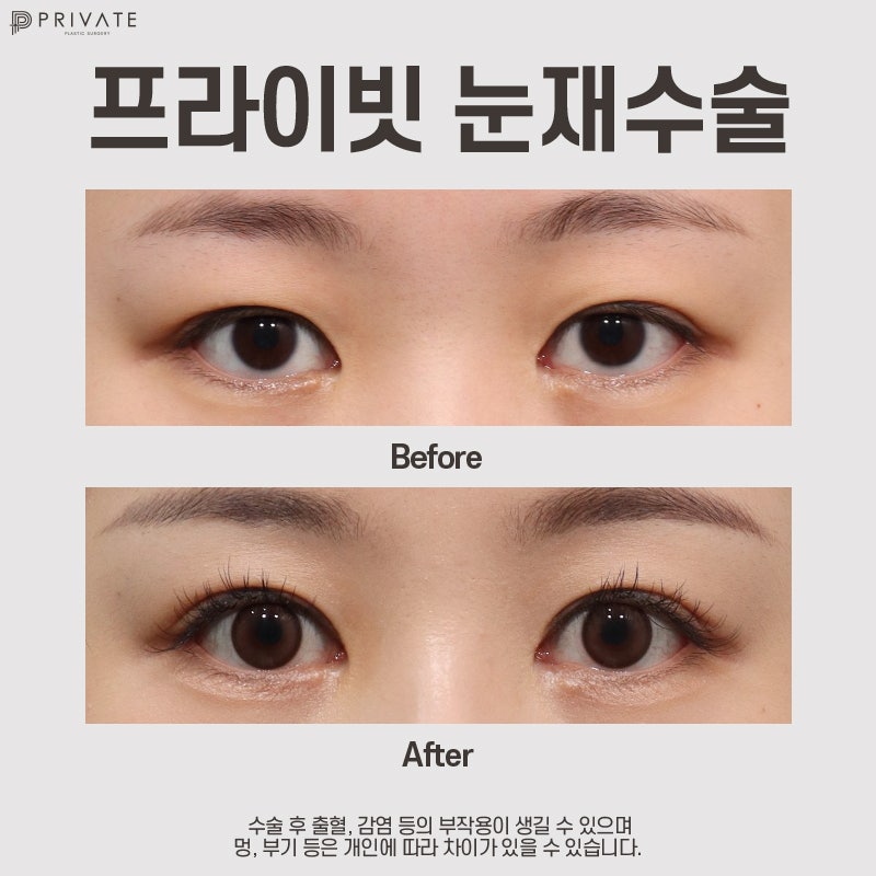 Jika Anda mencari tempat yang bagus untuk operasi revisi kelopak mata ganda, Private Plastic Surgery adalah jawabannya.