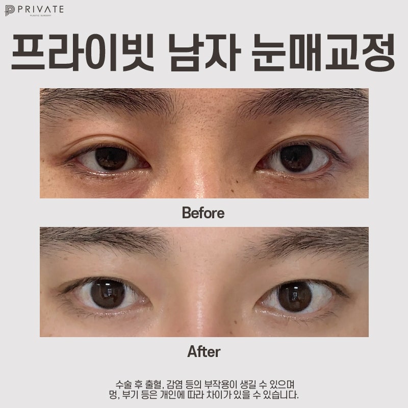 Perbedaan Sebelum dan Sesudah Koreksi Mata Pria yang Memuaskan di Private Plastic Surgery Sinsa 사진 9