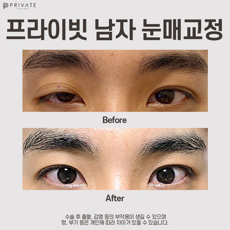 Perbedaan Sebelum dan Sesudah Koreksi Mata Pria yang Memuaskan di Private Plastic Surgery Sinsa 사진 10