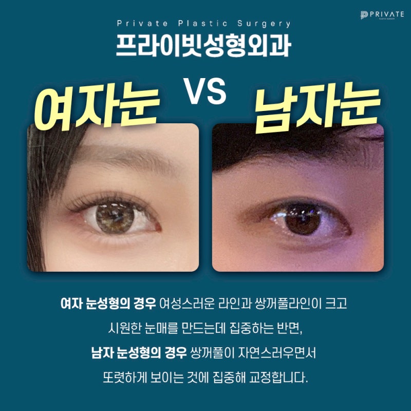 Perbedaan Sebelum dan Sesudah Koreksi Mata Pria yang Memuaskan di Private Plastic Surgery Sinsa 사진 4
