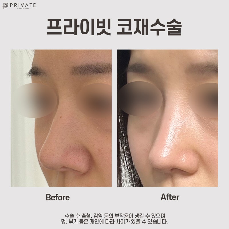 Klinik Bedah Plastik Revisi Hidung adalah Klinik Bedah Plastik Privat 사진 8